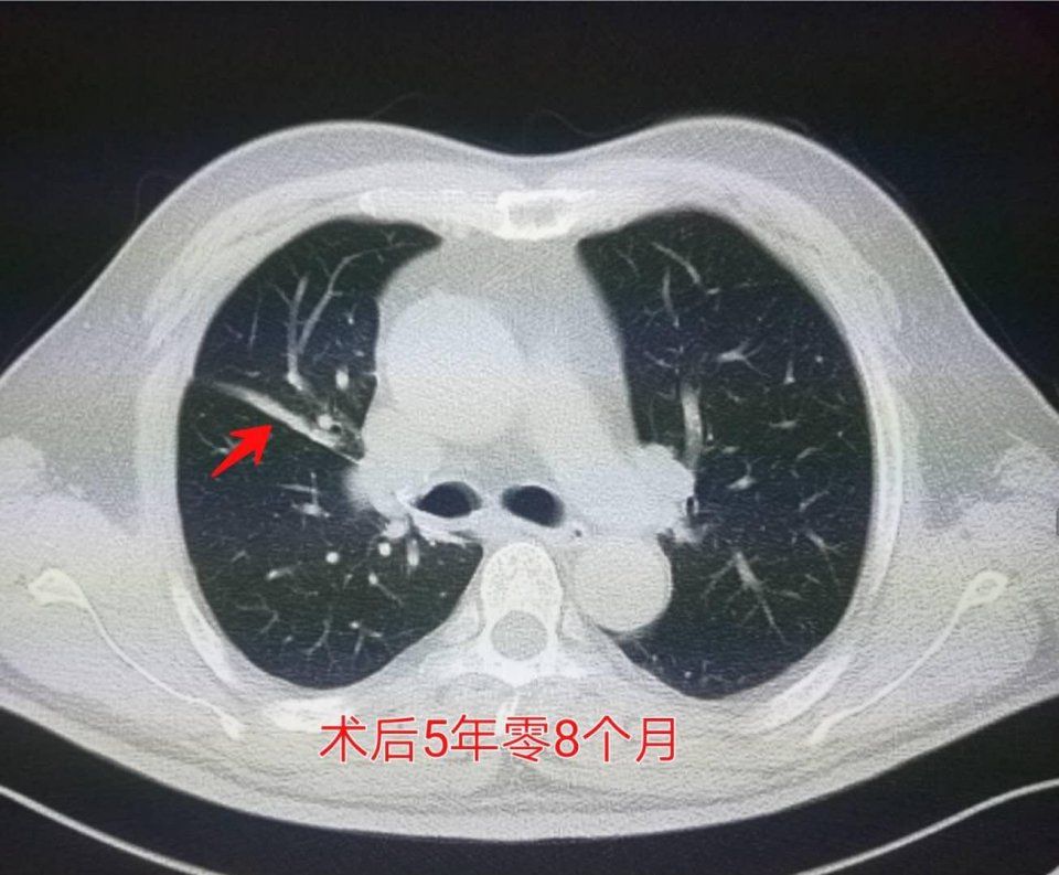 女子查出肺结节不重视，终成肺癌晚期的警示故事_资料解释