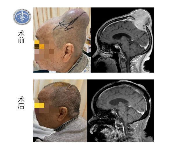 车祸后CT查出脑瘤，医生未告知？探究事件真相