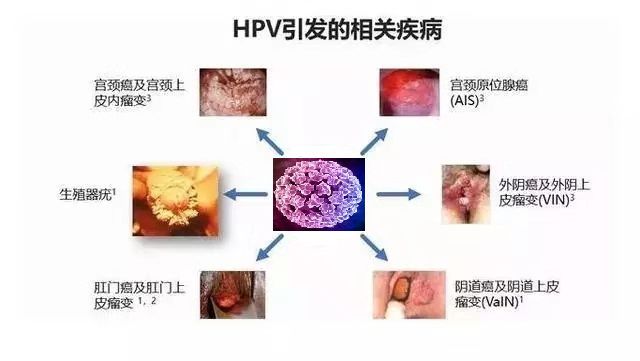 66岁单身大妈养生局遭遇HPV感染，背后真相引人深思