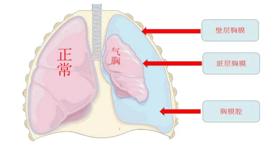 揭秘爆肺真相，一探究竟！你的健康警报已拉响！