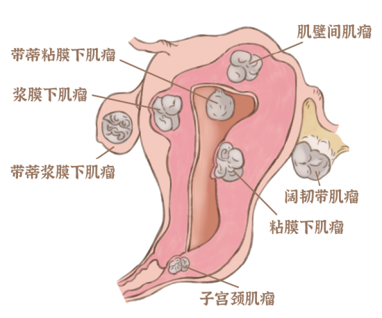 女子每天喝奶茶竟致子宫肌瘤大如馒头，引发健康警示热潮！